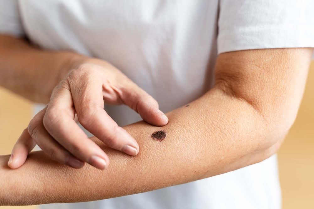 Estrategias de prevención del cáncer de piel